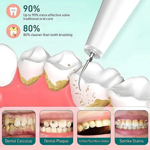 Electric Dental Calculus Remover - Ultrasound Stains Teeth Polishing