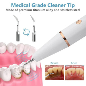 Electric Dental Calculus Remover - Ultrasound Stains Teeth Polishing
